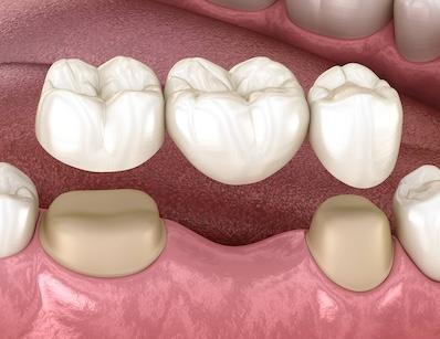 Dental bridge going into a set of teeth, ashburn va