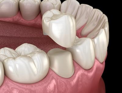 close up of dental crown | dental crowns ashburn va