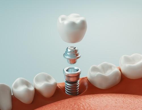 Picture showing a dental implant being installed, ashburn va