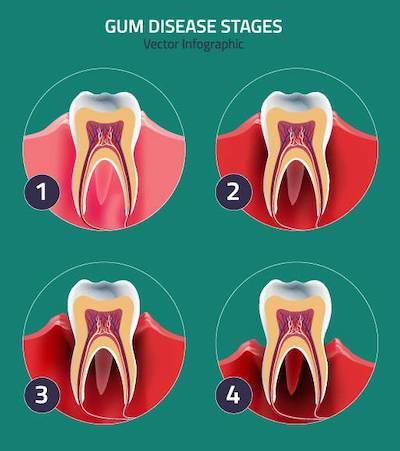 Gum disease stages graphic, ashburn va