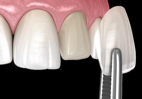 Image of veneers being put on teeth, ashburn va