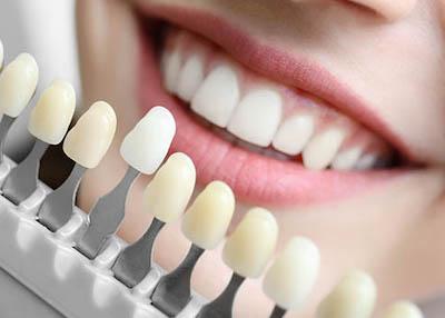 Teeth whitening options being displayed next to a womans mouth, ashburn va