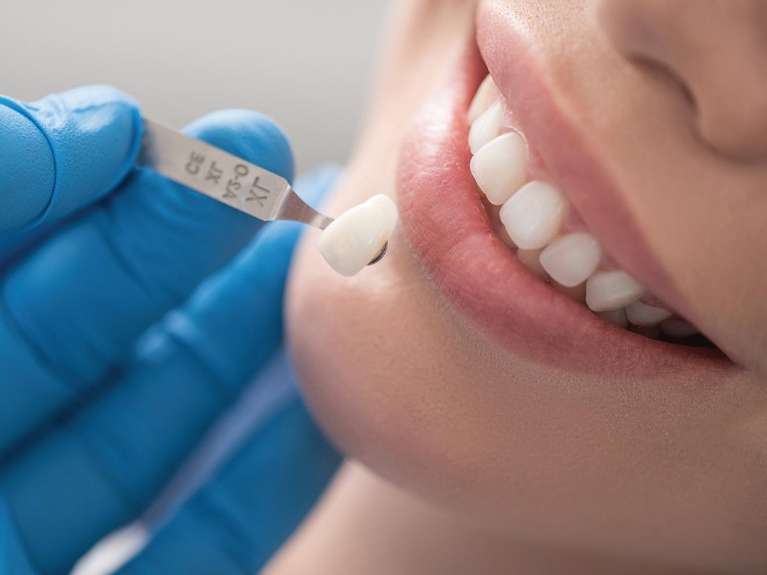 Women getting fitted for porcelain veneers, ashburn va