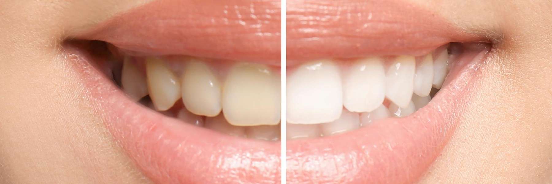 Before and after image of teeth using teeth whitening, ashburn va