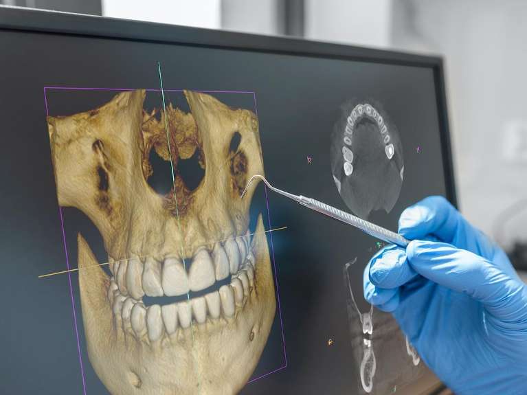 3-D Cone Beam Computed Tomograhy (CBCT) at posh smiles in ashburn va