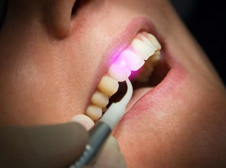 Laser dentistry being used on a patient at posh smiles in ashburn va