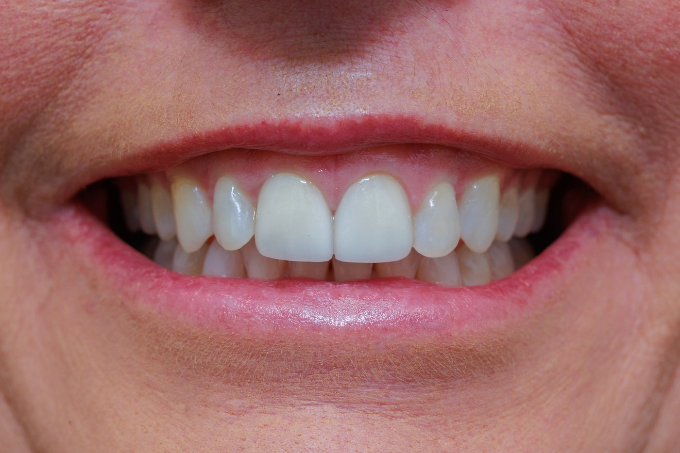 Close-up of a bright, healthy smile following professional teeth whitening at POSH Smiles in Ashburn, VA